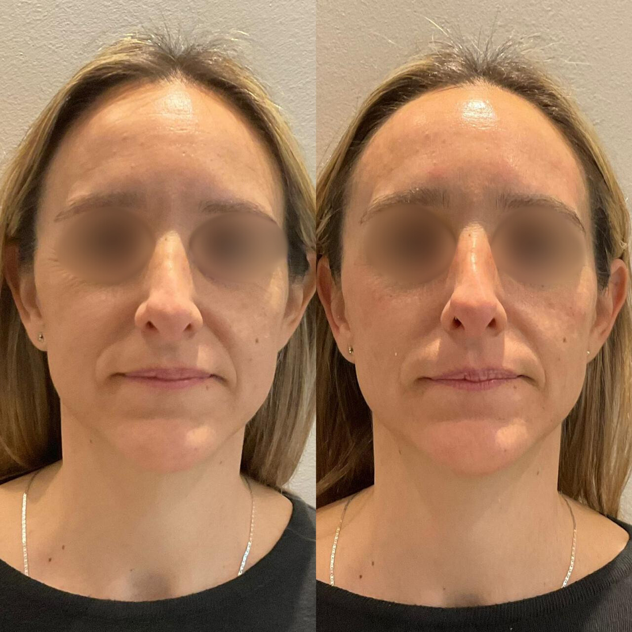 Antes y después - Armonización facial integral