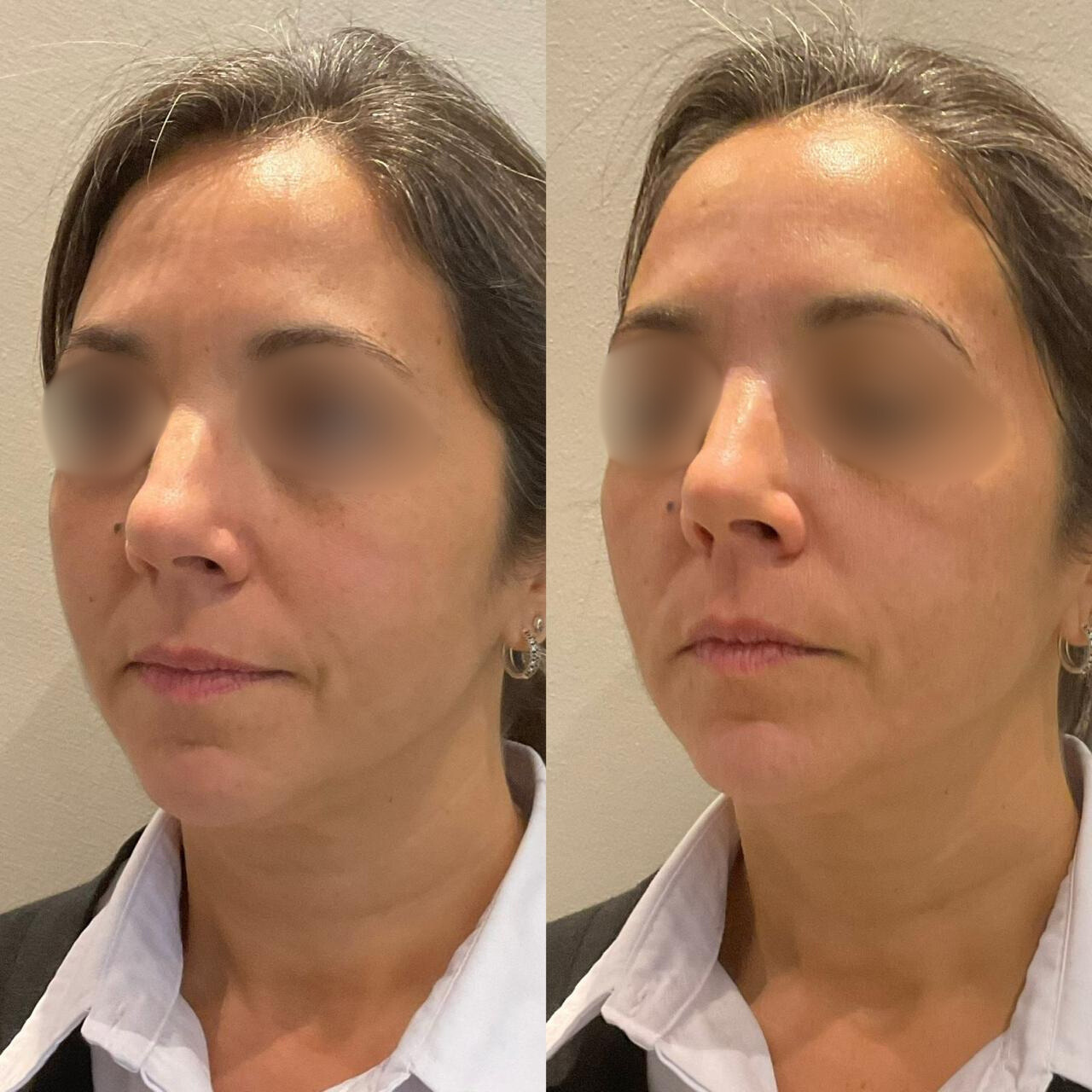 Antes y después - Rejuvenecimiento facial