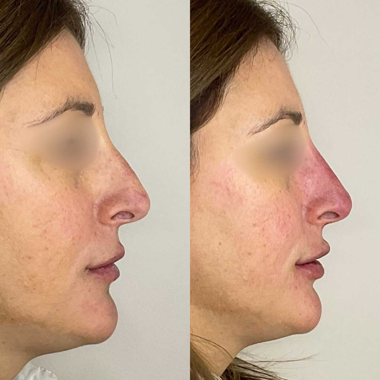 Antes y después - Rinomodelación y labios con ácido hialurónico